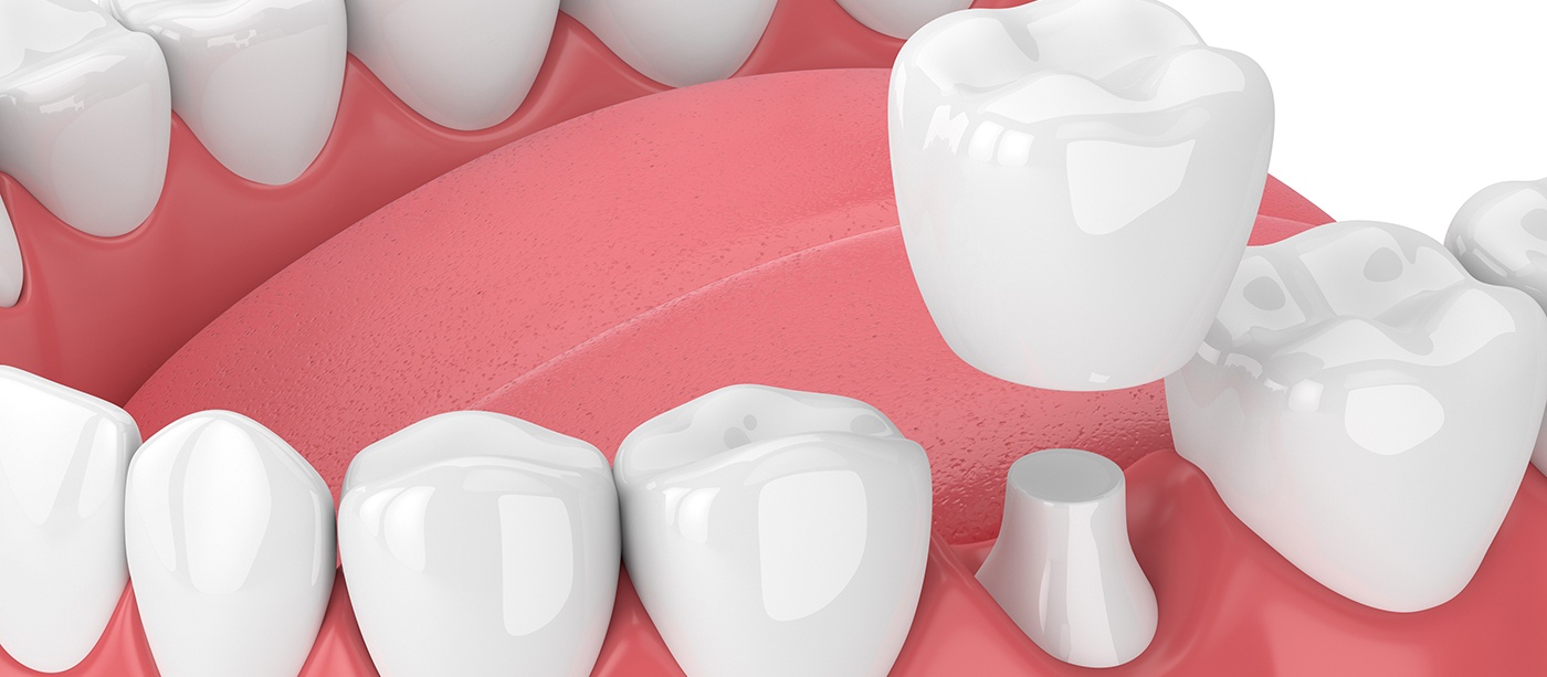 High quality restorations are just one reason to choose Advanced Dental Care of South Texas for your dental crowns