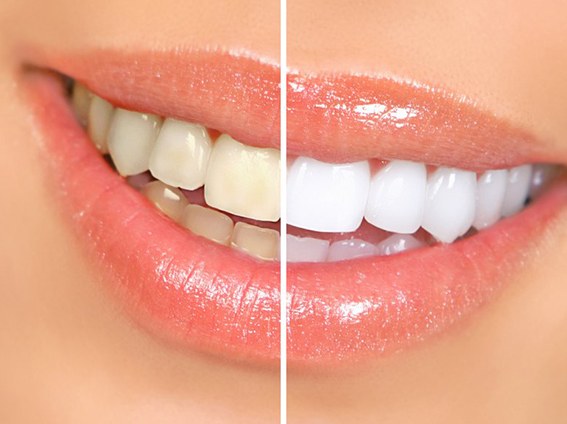 Before-after side-by-side of stained and whitened teeth