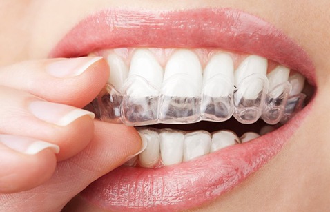 Extreme close up of someone inserting take-home whitening tray